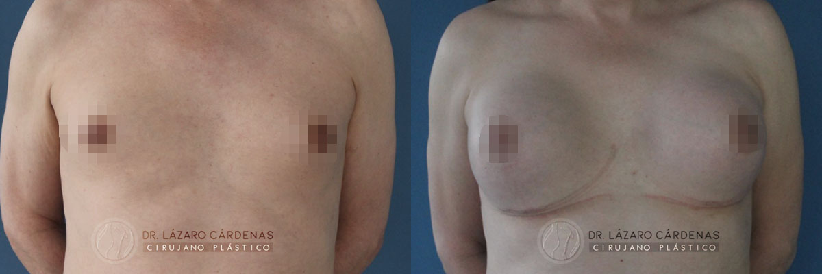 Colocación de Implante mamario - Dr Lázaro Cárdenas - - Caso 1 A
