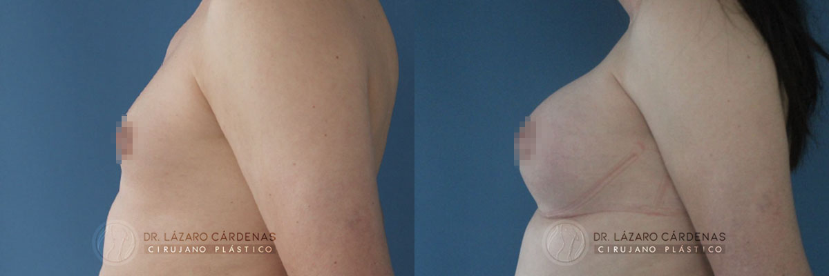 Colocación de Implante mamario - Dr Lázaro Cárdenas - Caso 1 B