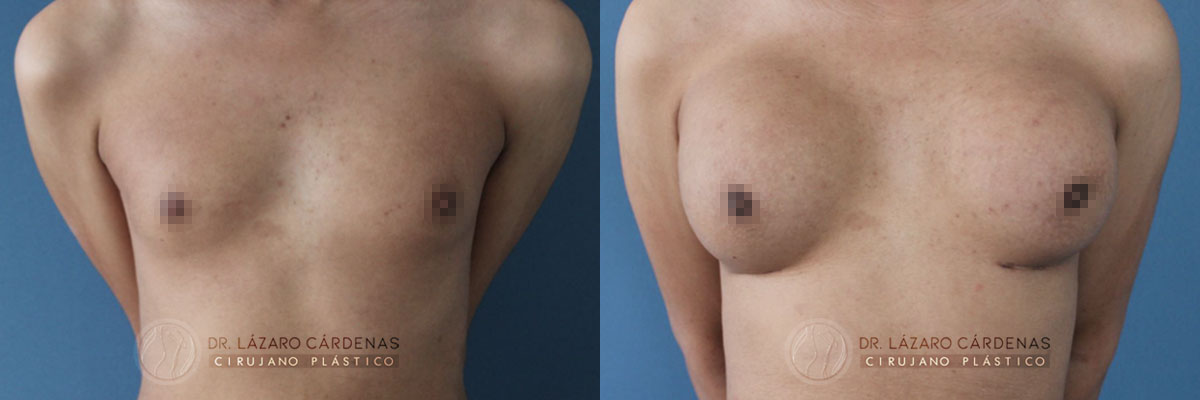 Colocación de Implante mamario - Dr Lázaro Cárdenas - Caso 2 A