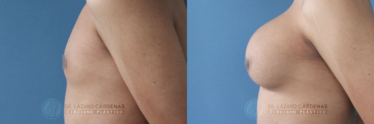 Colocación de Implante mamario - Dr Lázaro Cárdenas - Caso 2 B