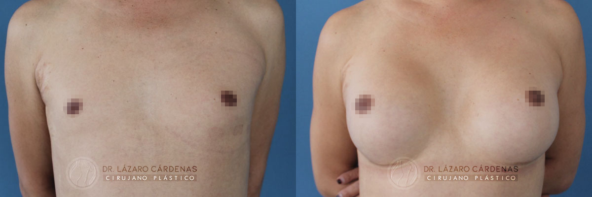 Colocación de Implante mamario - Dr Lázaro Cárdenas - Caso 3 A