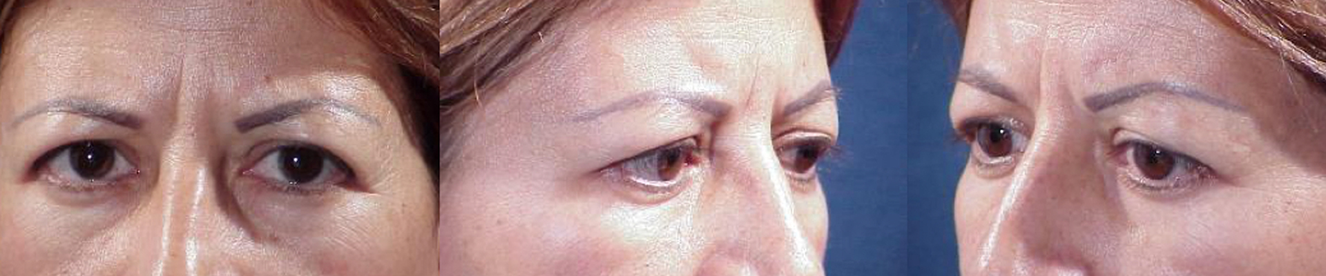 Ritidoplastia - Rejuvenecimiento facial