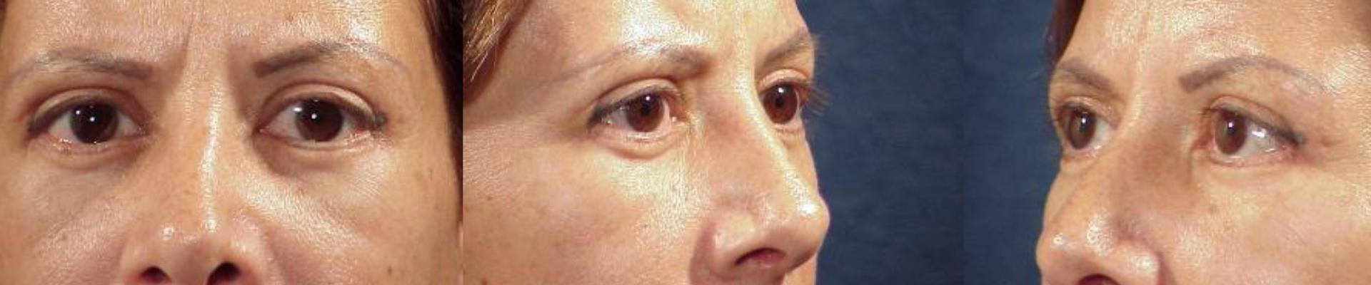 Ritidoplastia - Rejuvenecimiento facial