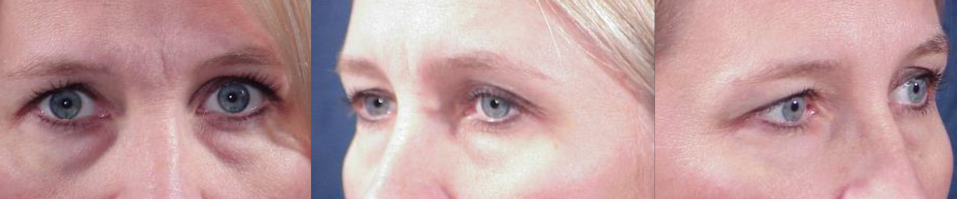 Ritidoplastia - Rejuvenecimiento facial