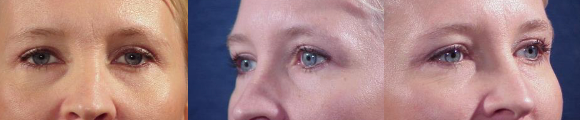 Ritidoplastia - Rejuvenecimiento facial