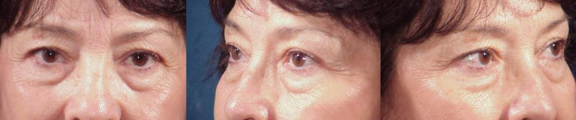 Ritidoplastia - Rejuvenecimiento facial