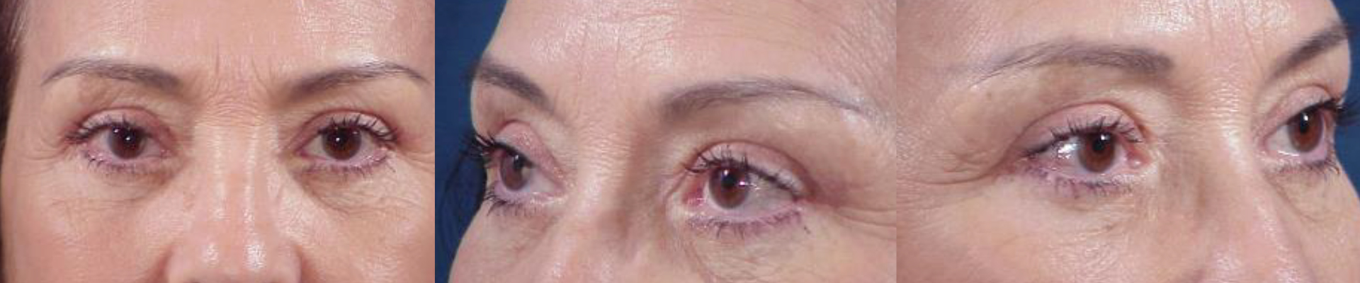 Ritidoplastia - Rejuvenecimiento facial