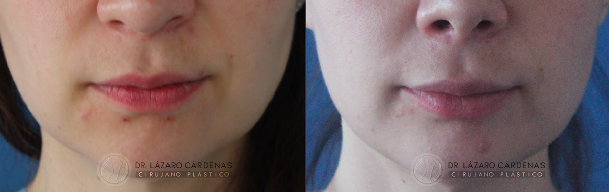 Aumento de labios con infiltración de grasa - Dr Lazaro Cárdenas Caso 1