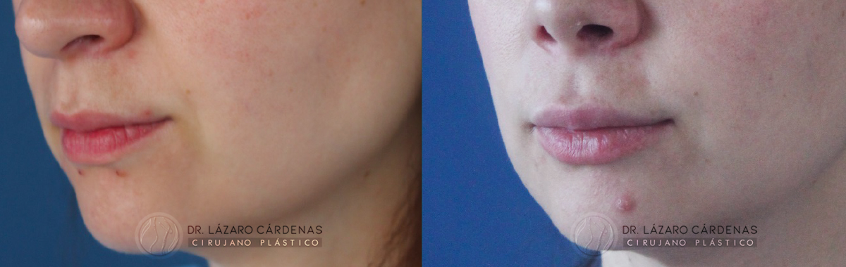 Aumento de labios con infiltración de grasa - Dr Lazaro Cárdenas Caso 2