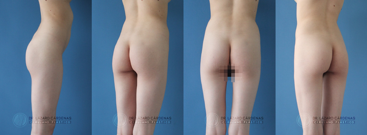 Cirugía Corporal - Glúteoplastia - Dr. Lázaro Cárdenas - Caso 1 B