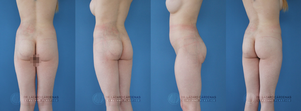 Cirugía Corporal - Glúteoplastia - Dr. Lázaro Cárdenas - Caso 2 A