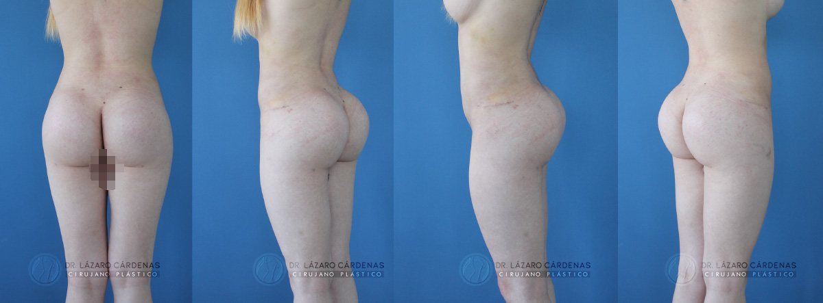 Cirugía Corporal - Glúteoplastia - Dr. Lázaro Cárdenas - Caso 2 B