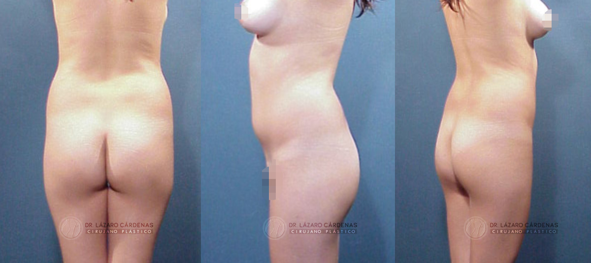 Cirugía Corporal - Lipoescultura - Dr. Lázaro Cárdenas - Caso 2 A