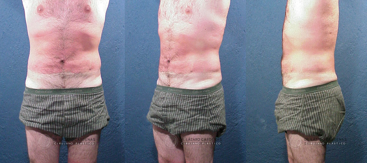 Cirugía Corporal - Lipoescultura - Dr. Lázaro Cárdenas - Caso 3 B