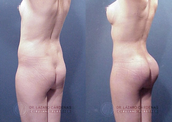 Cirugía Corporatl - Infiltración de grasa corporal - Dr. Lázaro Cárdenas - Caso 1 B