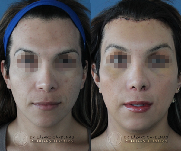 Cirugía de Implante de pómulo - Dr. Lázaro Cárdenas - Caso 1 A