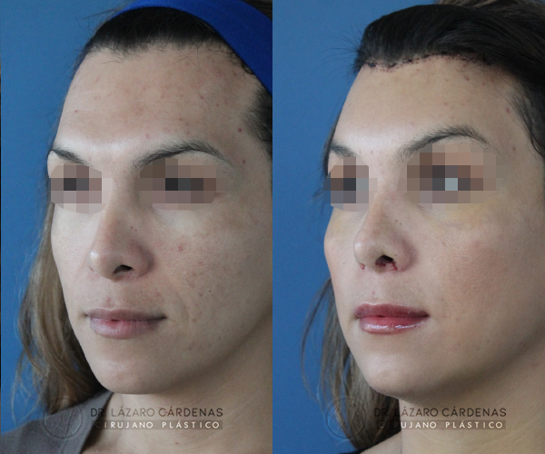 Cirugía de Implante de pómulo - Dr. Lázaro Cárdenas - Caso 1 B