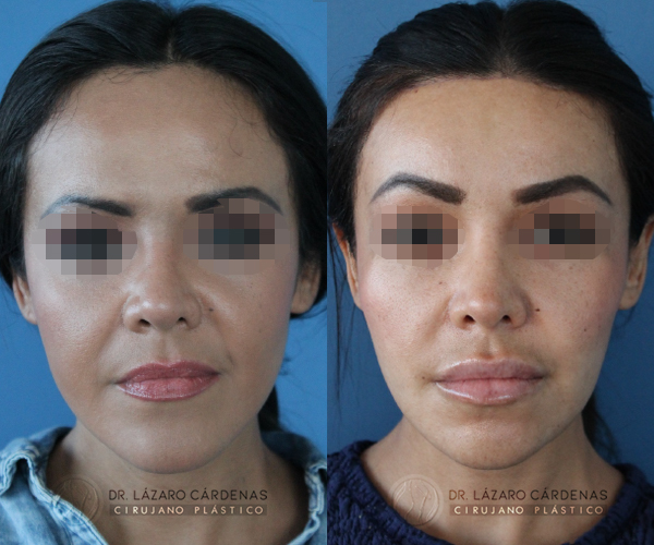 Cirugía de Implante de pómulo - Dr. Lázaro Cárdenas - Caso 2 A