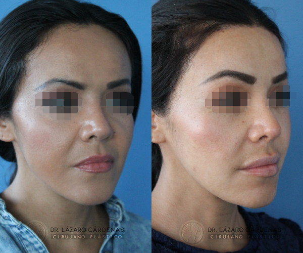 Cirugía de Implante de pómulo - Dr. Lázaro Cárdenas - Caso 2 B