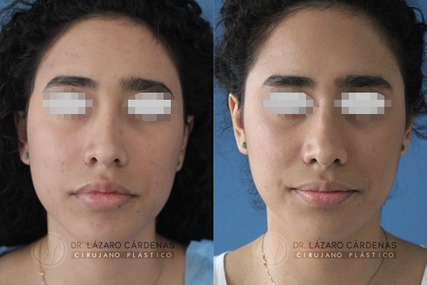 Cirugía de Nariz – Eliminación de giba