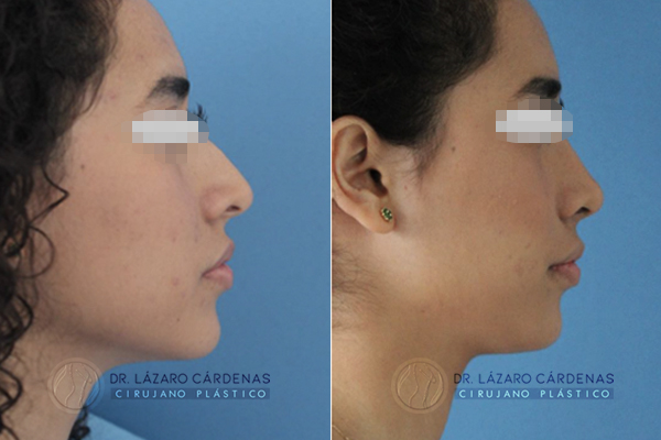 Cirugía de Nariz – Eliminación de giba