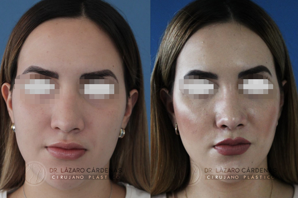 Cirugía de Nariz – Eliminación de giba