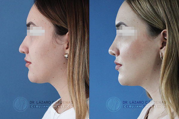 Cirugía de Nariz - Caso 2 B