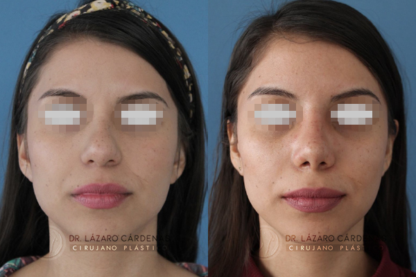 Cirugía de Nariz – Remodelación de la punta