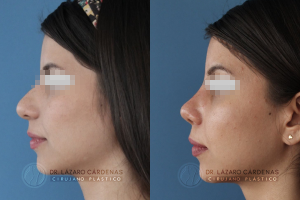 Cirugía de Nariz – Remodelación de la punta
