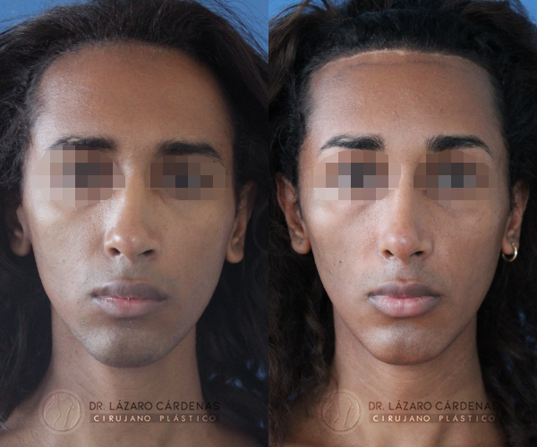 Cirugía de Pómulos - Dr. Lázaro Cárdenas - Caso 1 A