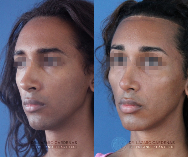 Cirugía de Pómulos - Dr. Lázaro Cárdenas - Caso 1 B