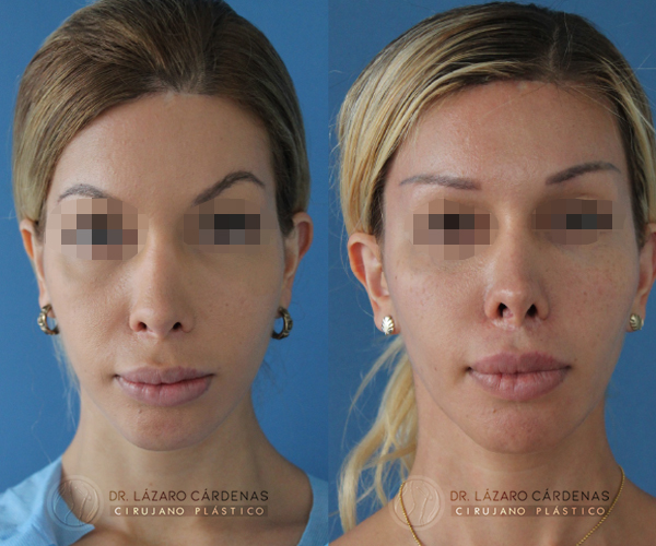 Cirugía de Pómulos - Dr. Lázaro Cárdenas - Caso 4 A