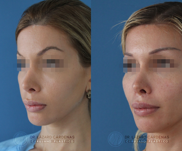 Cirugía de Pómulos - Dr. Lázaro Cárdenas - Caso 4 B