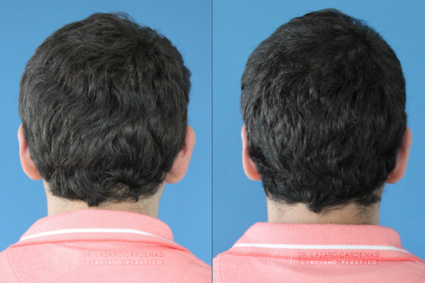 Cirugía de orejas - Caso 1 B