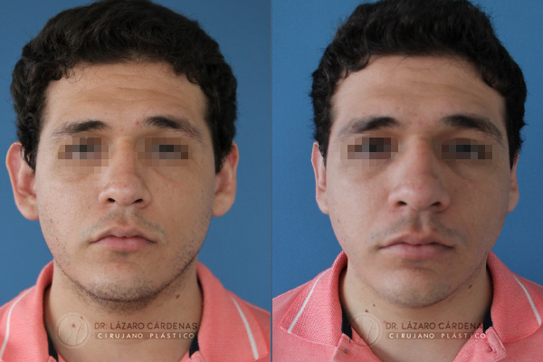 Cirugía de orejas - Caso 1