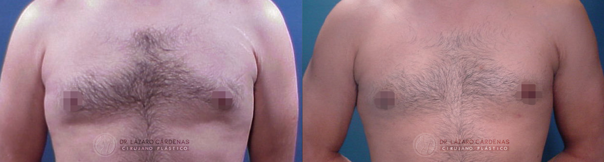 Ginecomastia - Dr. Lázaro Cárdenas - Caso 1 A