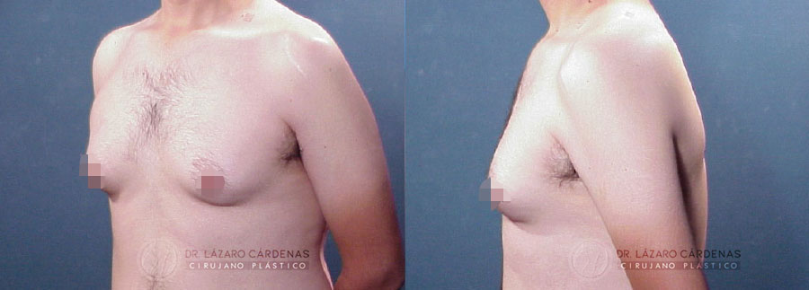 Ginecomastia - Dr. Lázaro Cárdenas - Caso 3 A