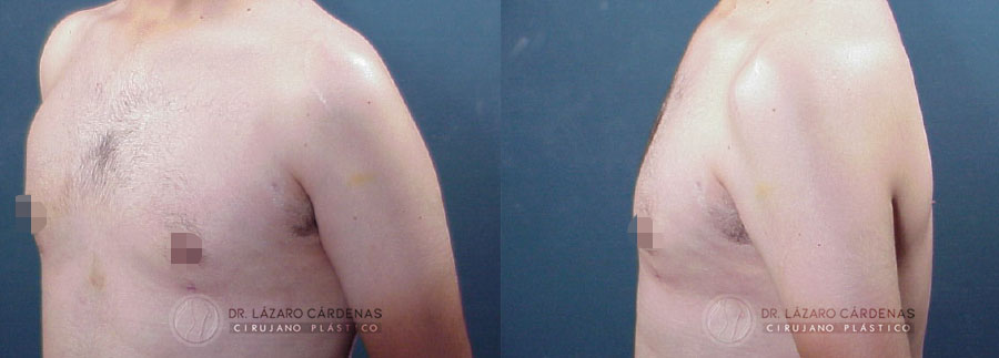 Ginecomastia - Dr. Lázaro Cárdenas - Caso 3 B