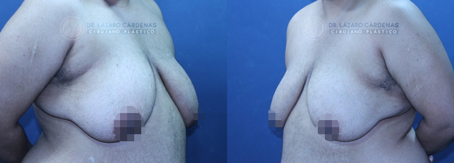 Mastectomía mayor FTM - Dr. Lázaro Cárdenas - Caso 1 A