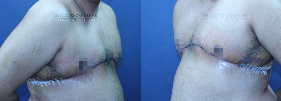 Mastectomía mayor FTM - Dr. Lázaro Cárdenas - Caso 1 B