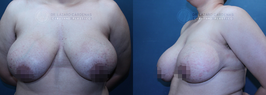 Mastectomía mayor FTM - Dr. Lázaro Cárdenas - Caso 2 A