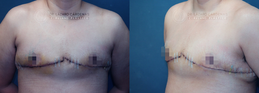 Mastectomía mayor FTM - Dr. Lázaro Cárdenas - Caso 2 B