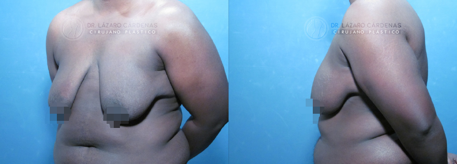 Mastectomía mayor FTM - Dr. Lázaro Cárdenas - Caso 3 A