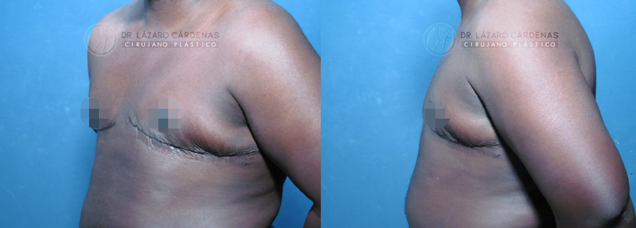 Mastectomía mayor FTM - Dr. Lázaro Cárdenas - Caso 3 B