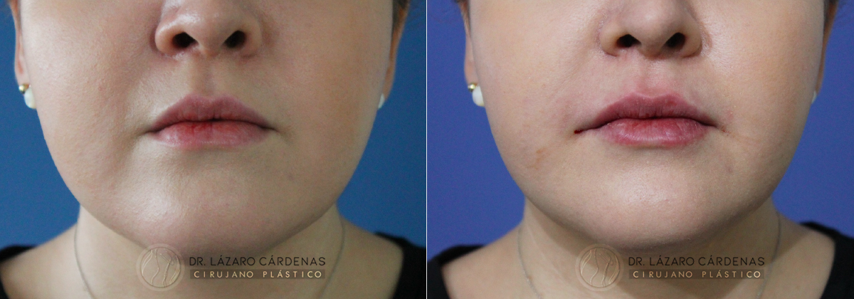 Rellenos Faciales - Dr Lazaro Cárdenas Caso 1