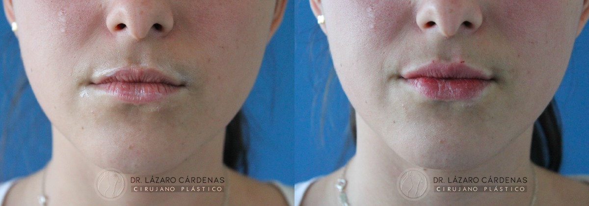 Rellenos Faciales - Dr Lazaro Cárdenas Caso 2