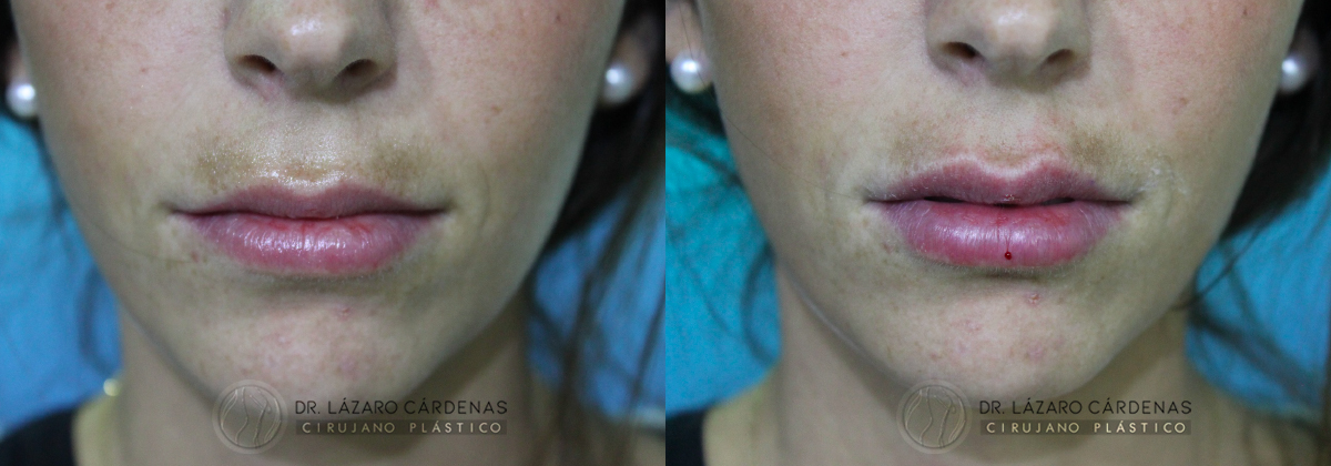 Rellenos Faciales - Dr Lazaro Cárdenas Caso 3
