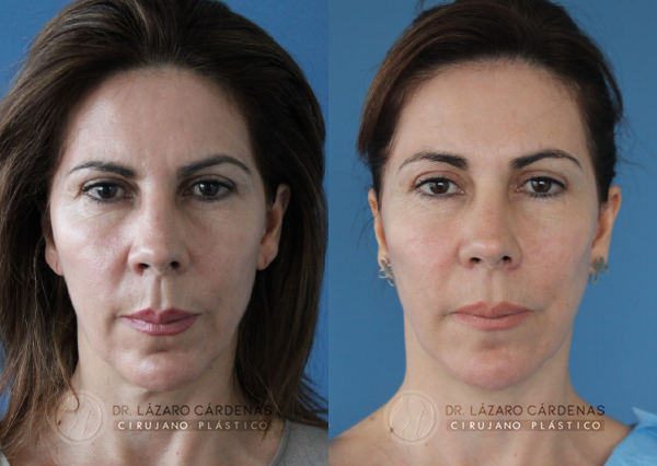Riti infiltración de grasa en cara - Dr. Lázaro Cárdenas - Caso 1 A